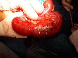 Right colon volvulated on the ileocolonic axis with several plaques of transmural necrosis.