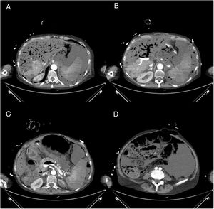 Abdominal CT findings. (A) Presence of intense portal pneumatosis with hypoattenuation of the liver and spleen parenchyma suggestive of ischaemia, as well as abundant free abdominal fluid. (B) Visualisation of hydro-air level in the portal venous system. (C) The hydro-air level is observed in the spleno-mesenteric axis. (D) Intense pneumatosis of the intestinal wall and pneumoperitoneum, suggestive of mesenteric ischaemia and intestinal perforation.