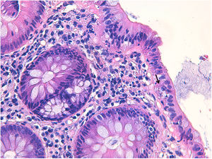 Findings consistent with apoptotic colitis, where an apoptotic body is observed in the colonic epithelium (arrow, hematoxylin-eosin x400).