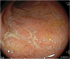 Endoscopic findings in the terminal ileum: deep snake-like ulcerations and cobblestone mucosa.