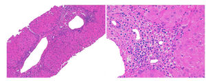 Liver biopsy, which shows septal fibrosis and periportal hepatitis with lymphoplasmocytic and eosinophilic infiltration.