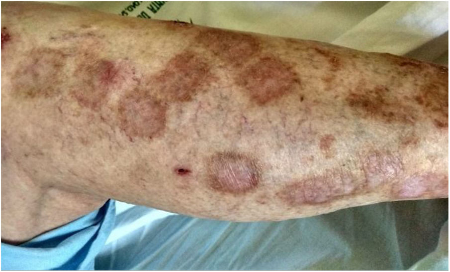 Immunotherapy-induced colitis: Could it be ulcerative colitis ...