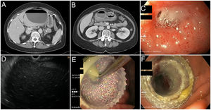 A-B) Abdominal CT images showing a large hypodense collection with an air-fluid level compatible with abscess, showing contact with the left lobe of the liver and with the gastric antrum. C) First gastroscopy. Duodenal bulb ulcer with a hole in its interior suggestive of perforation. D) Endoscopic ultrasound image of the abdominal collection from the gastric antrum. E) Moment of placement of the Hot-Axios® lumen-apposing stent with drainage of purulent material. F) Check-up after one week; open stent allowing access to a cavity now free of purulent material.