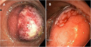 Endoscopic view of lipoma of the colon. A) Ulcerated mass. B) Friable surface with oozing bleeding.