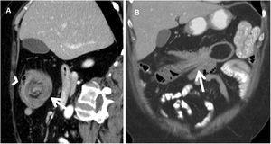 Computed tomography. A) Transverse view of intestinal intussusception; a “target” or “doughnut” image can be seen (arrow) with a lipoma in its centre, as well as mesenteric vessels and fat in the periphery (arrowhead). B) Longitudinal view of the intussusception; the colon can be seen with thickened walls and mesenteric fat and vessels entering the intussusception.