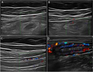 LIMBERG score: A) Grade O: no vessels; B) Grade 1 or barely visible: 1-2 points/cm2; C) Grade 2 or moderate: 3-5 points/cm2; D) Grade 3 or intense: >5 points/cm2 or even vessels outside the wall.