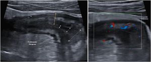A: Stricture of the lumen (dashed arrows indicate progressive narrowing of the lumen). It is accompanied by very evident creeping fat and an ulcer (asterisk). B: Marked Doppler signal (Limberg 2-3) indicating the presence of hyperaemia and it is therefore a stricture with inflammatory activity.