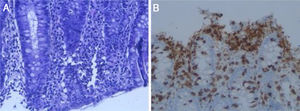 (A) Haematoxylin-eosin stain showing more than 30 lymphocytes for every 100 enterocytes. (B) Immunohistochemistry stain with CD3 as a T lymphocyte marker.