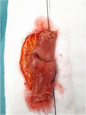 Macroscopic image of the surgical specimen: a hard, umbilicated endoluminal tumour measuring around 7 cm × 7 cm in the proximal ileum.