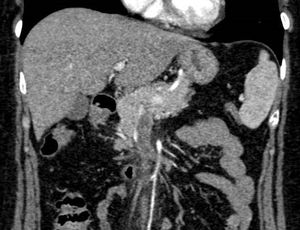 Coronal slice from the abdominal CT scan showing the filling defect in the splenic vein.