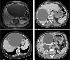 Case 1. Abdominal MRI: liver cyst measuring 20 cm in liver segment 6. It shows no wall enhancement following contrast administration (upper left). Case 2. Abdominal CT: cyst measuring 14 cm between liver segments 7 and 8 (upper right). Case 3. Abdominal CT: cyst measuring 18 cm. The upper portion features septations that raise suspicion of a hydatid cyst (lower left). Case 4. Abdominal CT: multiple liver cysts. The largest has a diameter of 12 cm (lower right).