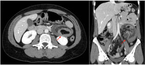 Abdominal CT scan. Jejunal intussusception (marked with arrows).