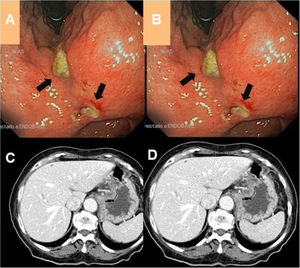 (A)(B) Gastroscopy images showing, by means of a retroversion manoeuvre, extensive ulceration and development of oedema affecting the lesser curvature of the stomach and the angular incisure (black arrows) spreading towards the antrum. (C)(D) Radiological extension study using contrast-enhanced CT with no notable abnormalities.