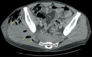 Axial view. Pneumoperitoneum (three yellow arrows on the left of the image).