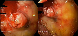 Endoscopic image of visible vessel on ulcer bed.