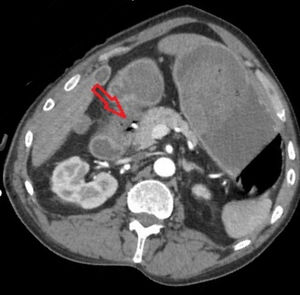 Sector image in arterial phase of CT angiography: gastroduodenal artery pseudoaneurysmal dilation.