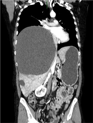 Computed tomography (TC) showed numerous hepatic cysts, the larger one of 20×16cm in diameter, that determines loss of volume of right hemithorax with mediastinal displacement towards the left side.