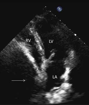 Echocardiogram showed compression of right atrium, inferior vena cava and suprahepatic veins by large hepatic cyst (white arrow). LA: left atrium; LV: left ventricle; RA: right atrium; RV: right ventricle.