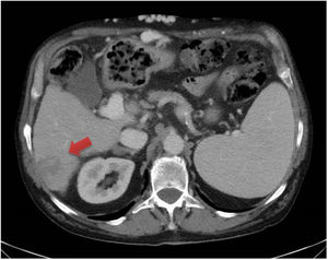 Cross-sectional view of abdominal computed tomography with intravenous contrast showing a space-occupying lesion 40 × 30 mm in size in liver segment 6 compatible with hepatocellular carcinoma.
