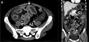 Abdominal CT scan. Diffuse thickening of the bowel loops (arrows) can be seen, as well as diffuse ascites (asterisks) in cross-sectional (A) and coronal (B) views.