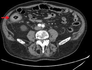 Abdominal CT: concentric wall thickening in the ascending colon.