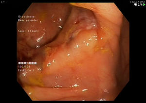 Endoscopic findings: ulcerated and circumferential lesion in the caecum.