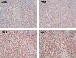 Histological image at 10× magnification which on immunohistochemical staining shows loss of nuclear expression in MLH1 and PMS2 (top photos) with intact nuclear expression for MSH2 and MSH6 (bottom photos).