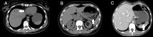 Unenhanced CT axial view showing gastric pneumatosis and portal pneumatosis (A and B). Portal phase showing gastric pneumatosis without portal pneumatosis (C).