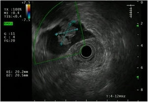 Conventional rectal endoscopic ultrasound image. Frequency 6MHz.
