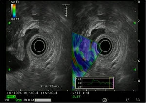 Rectal endoscopic ultrasound image elastography in which the lesion acquires a purplish hue that could simulate a neoplastic lesion.