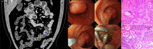 (A) Computed tomography enterography of the small intestines showed a distinctly enhanced nodular (arrow) in the distal jejunum. (B) The polyp showed an irregularly lobular surface. (C) The polyp is semi-pedunculated. (D) Single-balloon enteroscopic resection of the solitary Peutz-Jeghers hamartomatous polyp. (E) The surgical wound is clamped by titanium-clips. (F and G) Histopathologic specimens, demonstrating that smooth muscle bundles are covered with small intestinal mucosa (H&E with immunohistochemical staining).