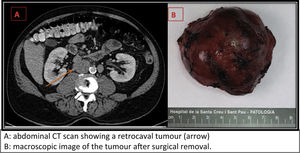 (A) Abdominal CT scan showing a retrocaval tumour (arrow). (B) Macroscopic image of the tumour after surgical removal.
