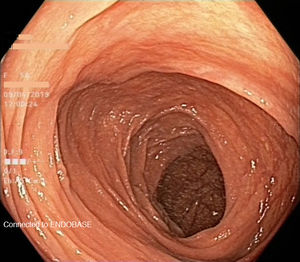 Colonoscopy. Colonic mucosa with a normal appearance.