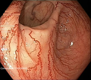 Colonoscopy. Perianastomotic region showing prominent neovascularisation with an arboriform pattern.