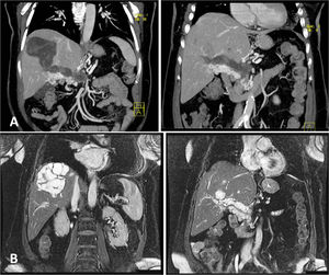 (A) CT scan showing multiple contrast material filling the portal lumen. (B) Magnetic resonance imaging T2-weighted that demonstrates two multilocular cysts that extent into the portal hilum and confirmed a communication between the cyst and portal vein.