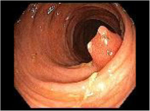 Endoscopic image of a pyloric gland adenoma in the transverse colon.
