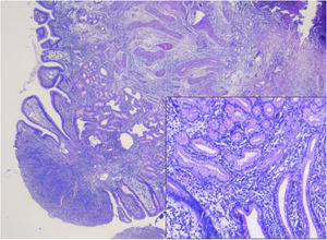 Anatomopathological image showing a polypoid structure with medium-sized tubular glands, some of them dilated, that appear to be coated in cylindrical epithelium with eosinophilic cytoplasm and isomorphic nuclei.