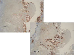 Immunohistochemical staining showing expression of MUC5 superficially and MUC6 in the deep glands.