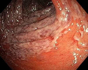 Endoscopic image with continuous involvement of the mucosa beginning abruptly in the hepatic flexure.