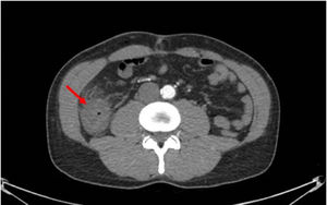 Axial cross-section from the Abdominal CT with contrast, showing thickening of the wall of the right colon with involvement of the mesenteric fat.