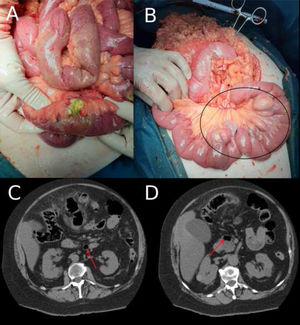 1A) Intraoperative image: perforation of a single large distal jejunal diverticulum. 1B) Intraoperative image: multiple large jejunal diverticula, on the mesenteric face, from practically the duodenojejunal flexure to 80 cm from the same (black circle). 1C and 1D) Abdominal and pelvic CT image, axial view. The image shows the jejunal diverticula (red arrows).