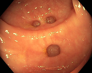 Colonic diverticulosis without signs of inflammation.