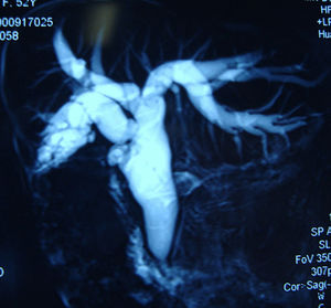 MRI showed both intrahepatic and extrahepatic dilations.