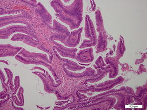 The biopsy specimens showed benign papillary adenomas.