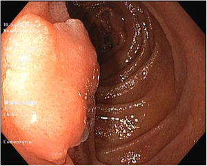 Upper endoscopic image revealing a non-granular laterally spreading tumor in the duodenum.