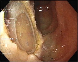 Endoscopic image showing the “target sign”.