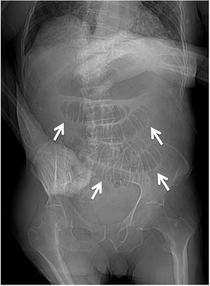 Abdominal X-ray showing small bowel loops distension (arrows) with absence of free abdominal air.
