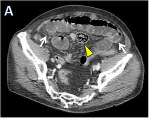 Abdominal CT axial and coronal showing small bowel loops distension (arrows) and an oval formation in a distal jejunal bowel loop.