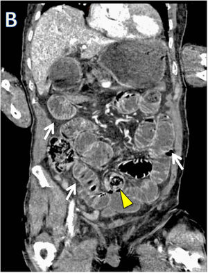 Abdominal CT axial and coronal showing small bowel loops distension (arrows) and an oval formation in a distal jejunal bowel loop.