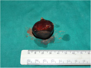 The foreign body (a chestnut) evacuated by the patient.
